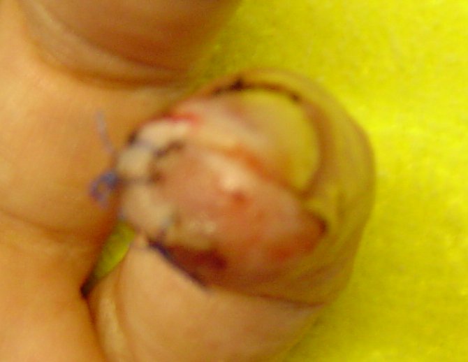 finger1